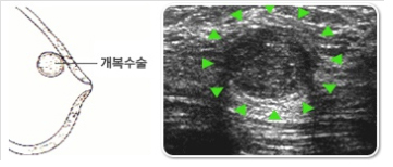 섬유선종