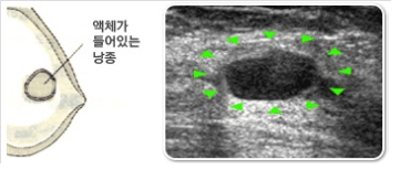 낭종