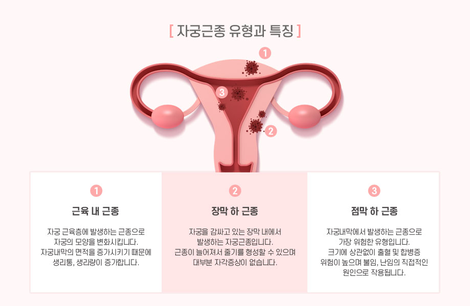 자궁근종유형과특징