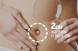 단일공복강경수술장점